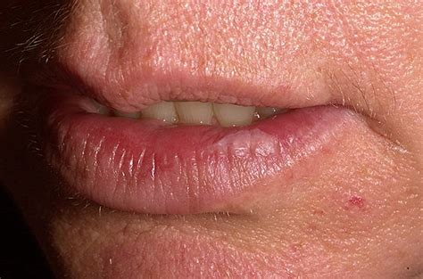 👉 Actinic Cheilitis - Pictures, Treatment, Symptoms, Causes (December 2021)