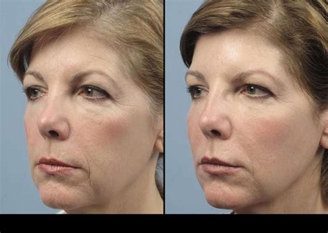 wrinkle removal  toronto tps
