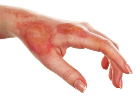 invasive method developed  assess burn wound healing