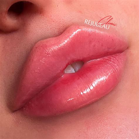 LIP FILLER GUIDE: WHAT TO KNOW BEFORE YOUR FIRST TREATMENT - Rejubeau