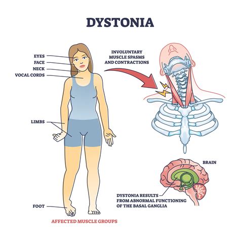 Cervical Dystonia Exercises Pdf at Bella Pflaum blog