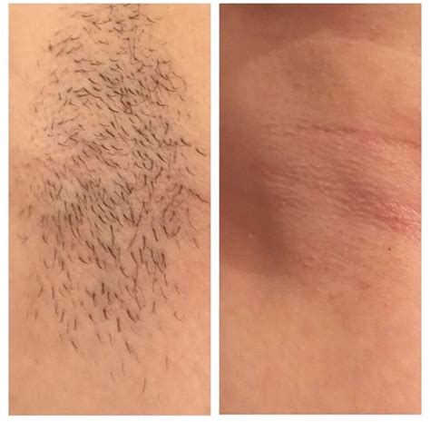 Laser Hair Removal Before And After Pcos at Austin George blog