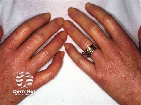 raynaud phenomenon image