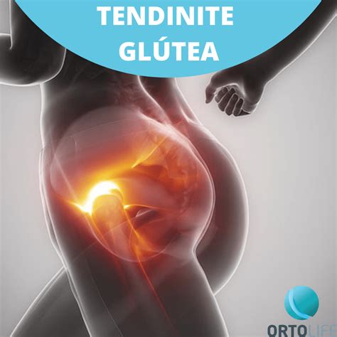 Tendinopatia Do Glúteo Médio E Mínimo Tem Cura - Peritendinite Dos Glúteos Médio E Mínimo - RETOEDU