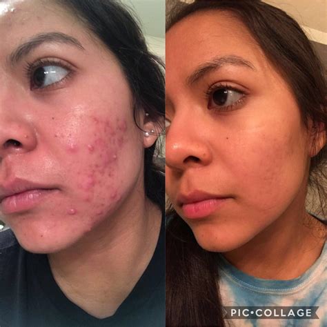 month  accutane   month  extremely happy