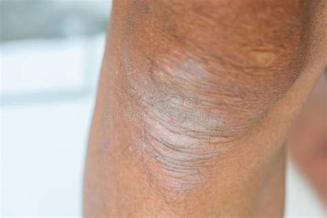 dry skin scab   person rough  wrinkled knee part stock photo