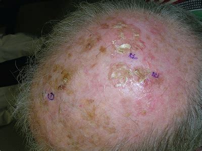 early squamous cell carcinoma scalp advanced squamous cell carcinoma