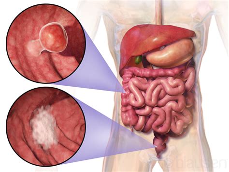 Colorectal Cancer – West Coast Surgical Oncology