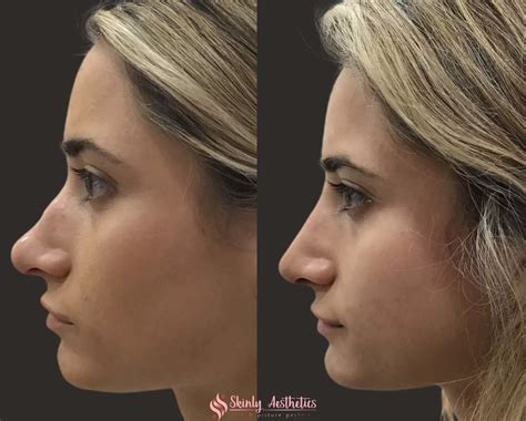 Non-Surgical Rhinoplasty - Before and After Results