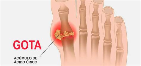 O Que Significa Gota - O que você sabe sobre Gota?