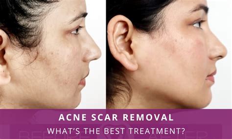 acne scar treatment  face  imelda metzger blog