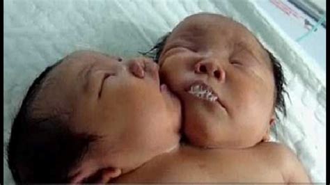 Chinese girls born in single body with 2 heads | cbs8.com