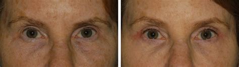 Blepharoplasty for Eye Rejuvenation