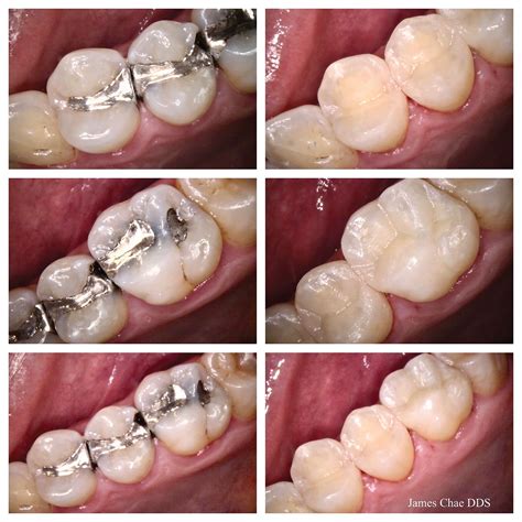 repair amalgam restorations  recurrent caries