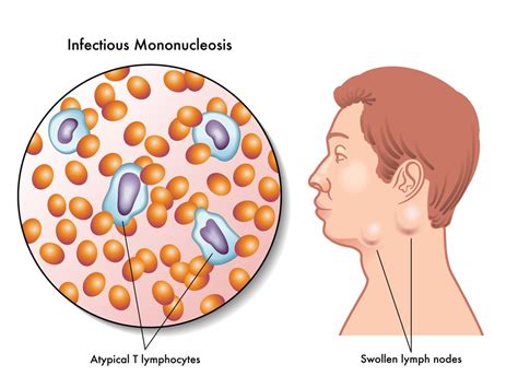 Mono (Infectious Mononucleosis) : Overview, Causes, Symptoms, Treatment ...