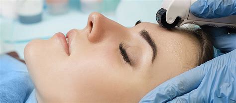 Microneedling Benefits and Side Effects