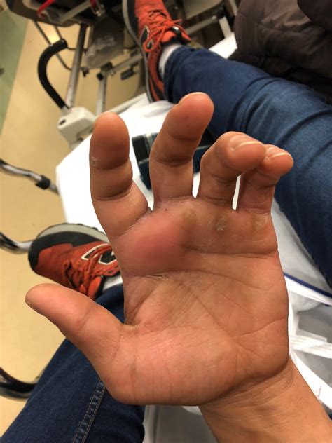 Collar button abscess – Handipedia