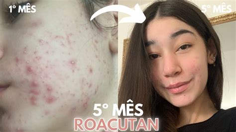 Roacutan Mês A Mês Fotos - 5º MÊS ROACUTAN | Diário Roacutan