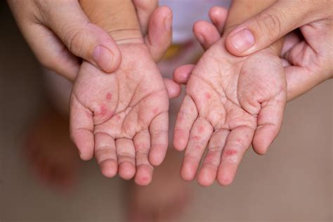 Hand Foot Mouth Disease On Adults Flash Sales | emergencydentistry.com