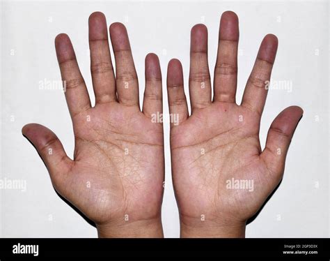 cyanosis hand  res stock photography  images alamy