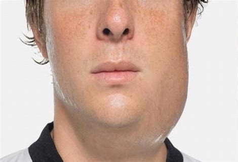 Mumps Symptoms, Causes, Complications, Diagnosis, Treatment and ...