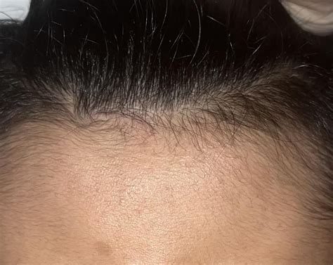 Hairline regrowth photos : r/TelogenEffluvium