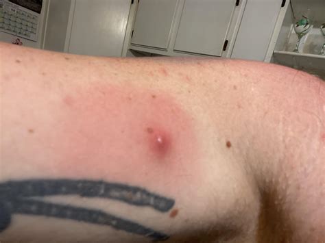 Brown Recluse Bite Pictures 30 Brown Recluse Spider Bite Stock Photos,
