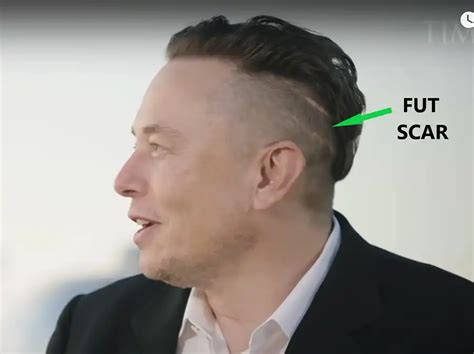 Elon Musk Hair Transplant l Before and After