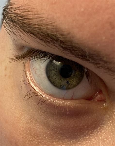 Eyelashes stick to eyelid - normal? : r/eyetriage