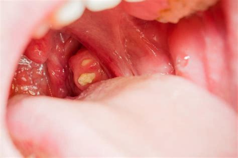 Q & A : What are tonsil stones and why do I get them? — Dr. Luke ...