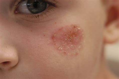 impetigo kimdeyir