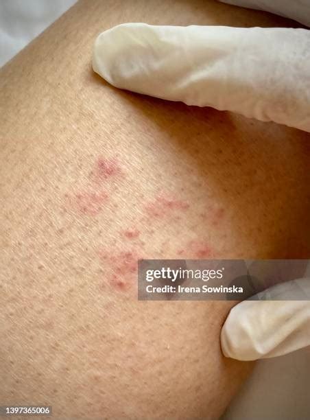 Herpes Zoster Rash Photos and Premium High Res Pictures - Getty Images