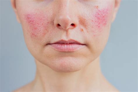 treatment  rosacea facial redness  dermatologist brisbane