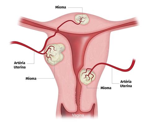 Miomas No Utero Imagens