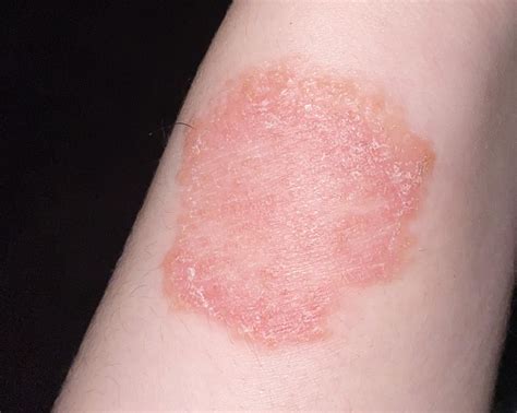 Ringworm Disease Information, Diagnosis, and Treatment