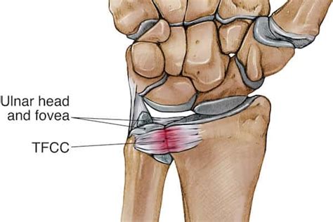 TFCC Tear | Masnad Health Clinic