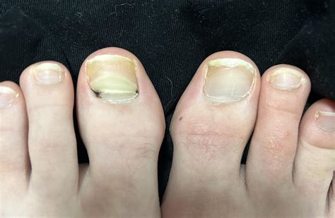 Toenail discolored and brittle- Leave it be or see a doctor? : r/medical