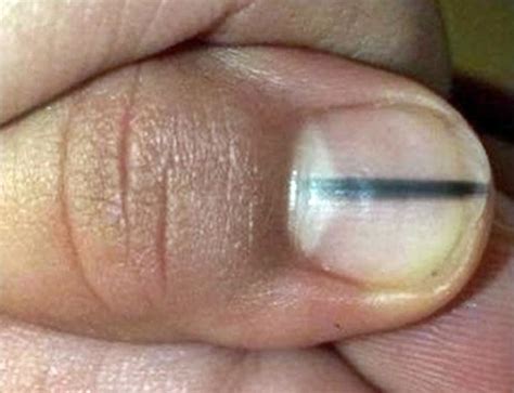 O Que Significa Uma Linha Preta Na Unha Do Dedão - Manchinhas Pretas Na Unha - RETOEDU