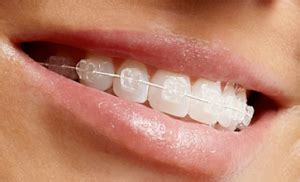 inspirasi behel keramik harganya