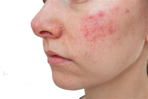 rosacea   improve  maintain  skins health skinbase