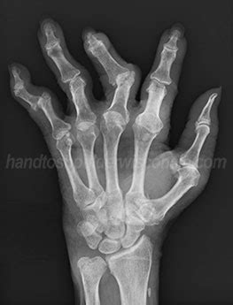 Hand to Shoulder Center of Wisconsin | Finger Fracture