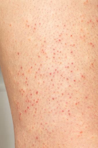 macro  female skin  folliculitis stock photo  image
