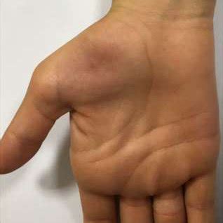 Dorsal view of both hands: pronounced thenar atrophy of the right hand ...