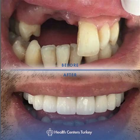 zygomatic implant  turkey health centers turkey