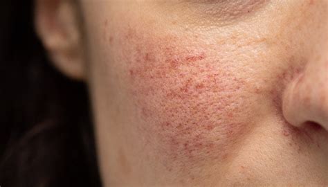 treat rosacea  symptoms types skinkraft
