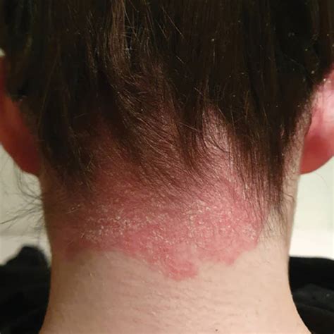 Scalp Psoriasis: Symptoms, Causes And Natural Treatment For Scalp Psor ...