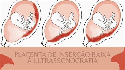 O Que Significa Placenta Baixa - Placenta de Inserção Baixa à Ultrassografia - YouTube