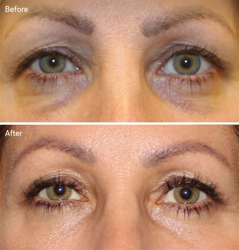 laser treatments  dark circles   worth   afters cost