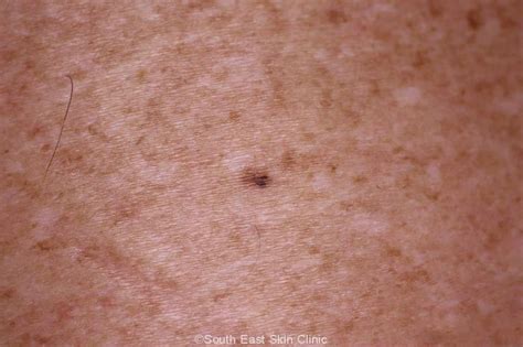 A Guide To The Atypical Mole - South East Skin Clinic