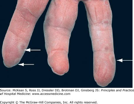 Osler Nodes Endocarditis